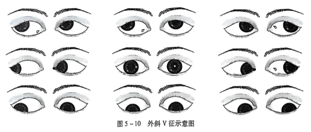 5-10外斜V征示意图.PNG