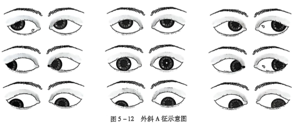 5-12外斜A征示意图.PNG