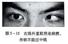 5-15右眼外直肌完全麻痹外转不能过中线.PNG
