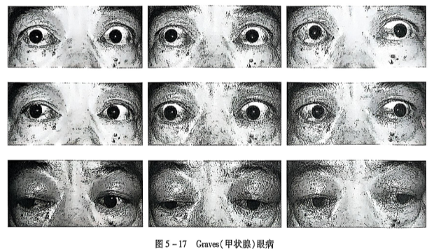 5-17 Graves(甲状腺)眼病.PNG