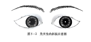 5-2先天性内斜视示意图.PNG