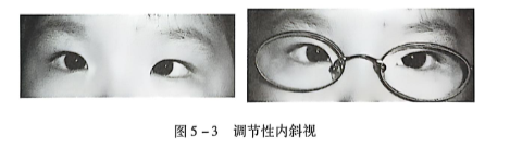 5-3调节性内斜视.PNG