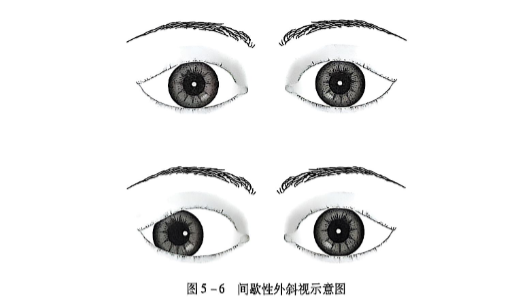 5-6间歇性外斜视示意图.PNG