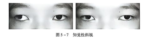 5-7知觉性斜视.PNG