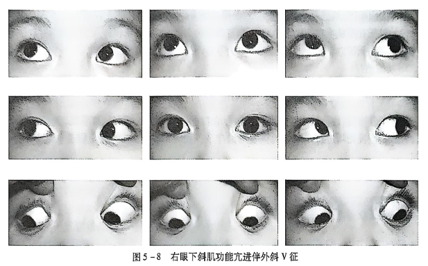 5-8右眼下斜肌功能亢进伴外斜v征.PNG