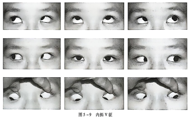5-9内斜V征.PNG