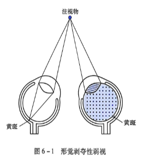 6-1醒觉剥夺性弱视.PNG