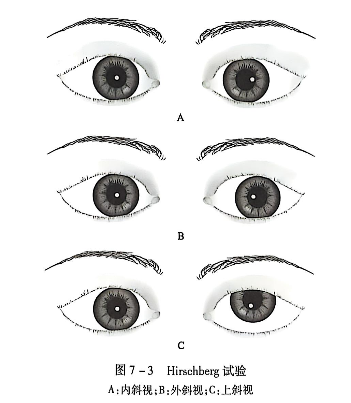 7-3Hirschberg试验A内斜视B外斜视C上斜视.PNG